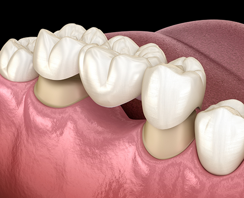 Illustrated dental bridge