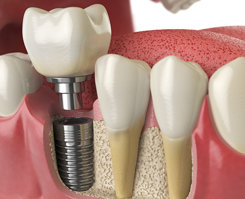 Illustrated dental implant